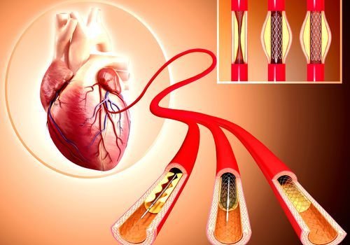 Angioplasty and stenting service at Trivedi Cardiac Care Clinic