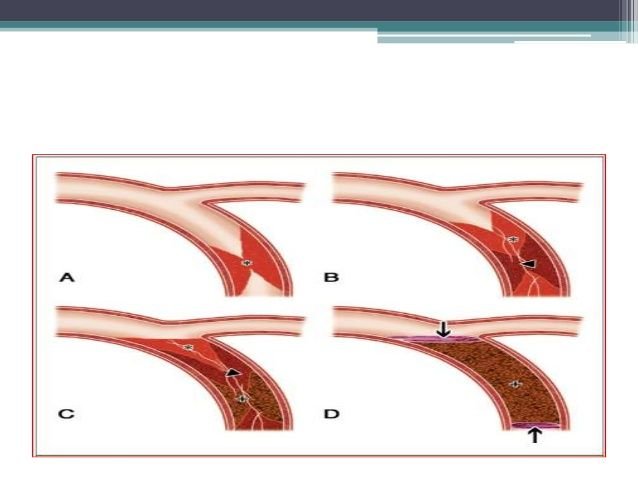 Complex PCI service at Trivedi Cardiac Care Clinic