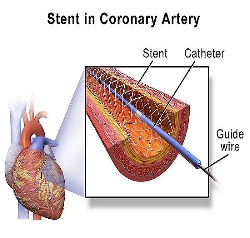Coronary interventions service at Trivedi Cardiac Care Clinic