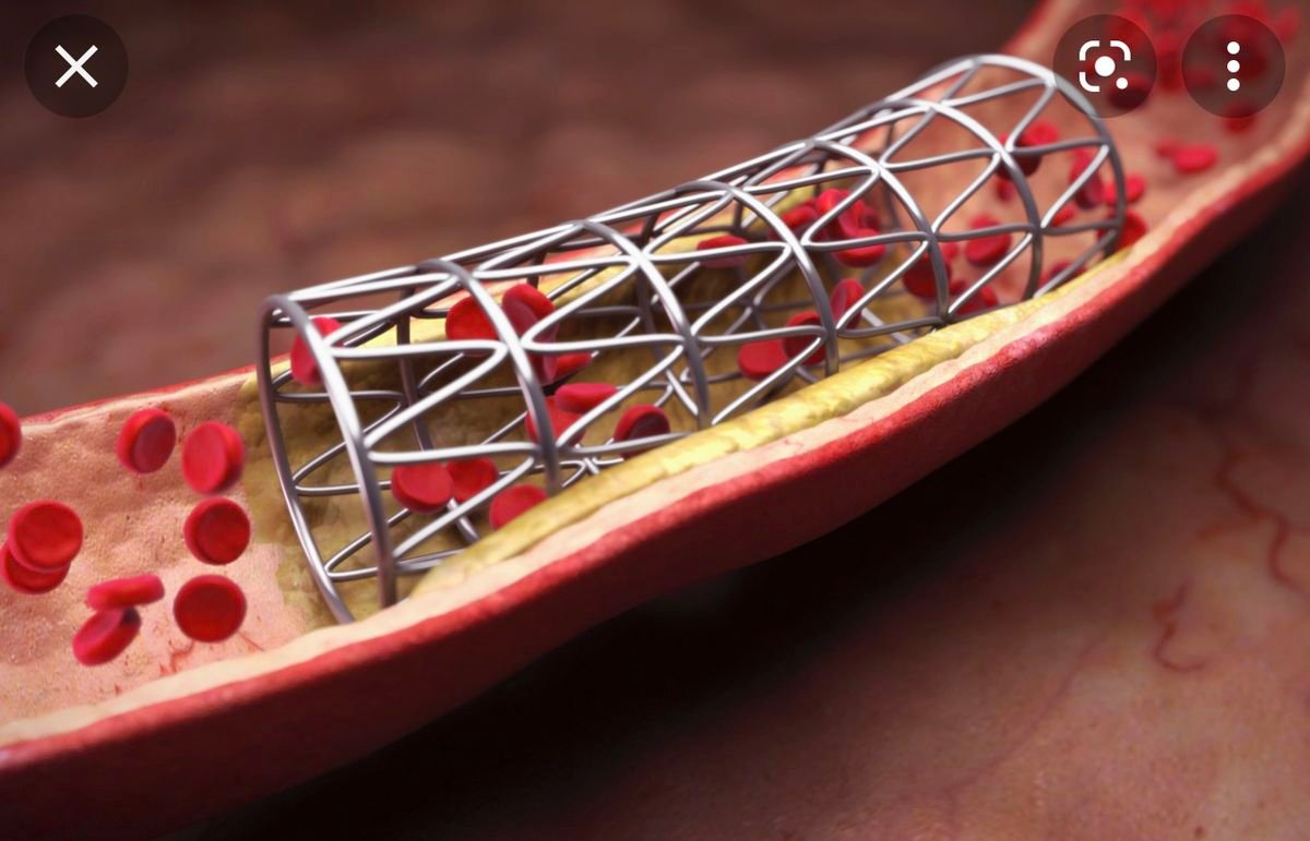 Primary angioplasty service at Trivedi Cardiac Care Clinic